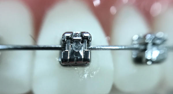 A closeup view of a self-ligating orthodontic bracket